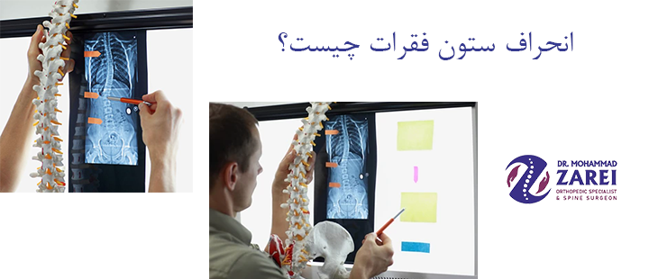 انحراف ستون فقرات چیست؟