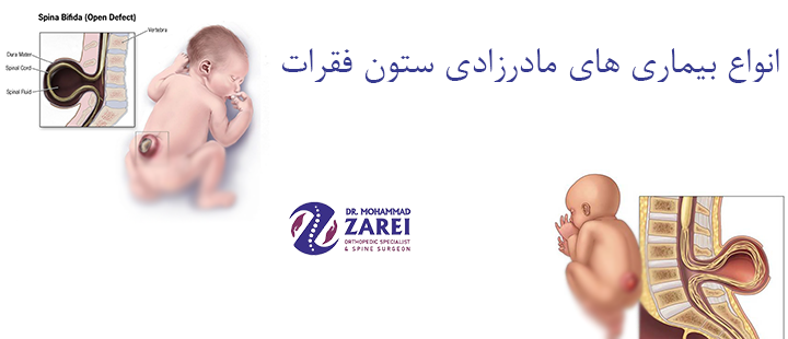 انواع بیماری های مادرزادی ستون فقرات