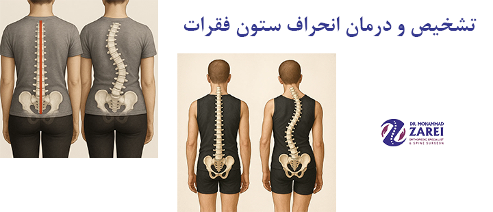 تشخیص و درمان انحراف ستون فقرات