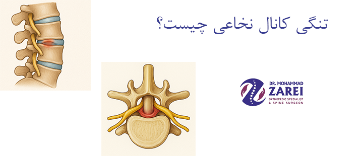 تنگی کانال نخاعی چیست؟