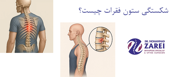 شکستگی ستون فقرات چیست؟