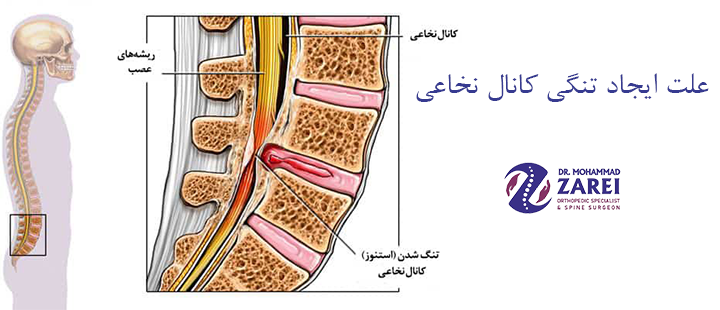 علت ایجاد تنگی کانال نخاعی