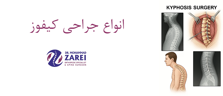 انواع جراحی کیفوز