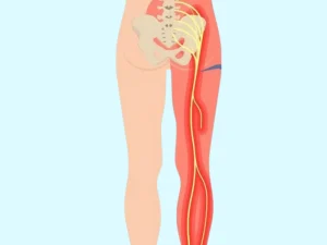 علائم دیسک کمر در پاها